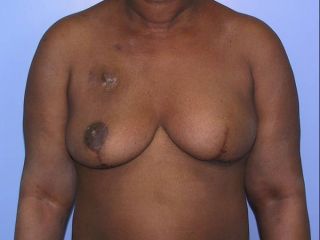 Breast reconstruction with mammary implant after wise-pattern skin-sparing mastectomy. Postoperative view. A controlateral reduction mammaplasty was performed