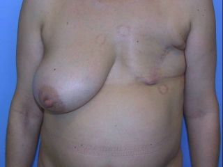 Breast reconstruction with lateral thoracodorsal flap + implant. Preoperative view
