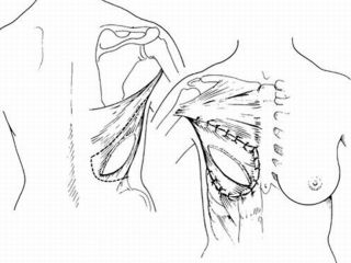 Schema: prelievo e posizionamento del lembo muscolo-cutaneo di Latissimus Dorsi