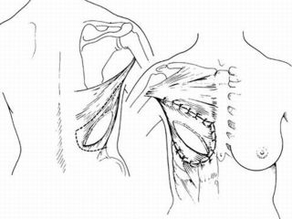 Harvesting and setting of Latissimus Dorsi myo-cutaneous flap (scheme)