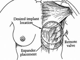 Introduction of mammary expander (scheme)
