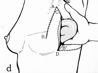 Breast reconstruction with lateral thoracodorsal flap + implant. Scheme of the implant introduction