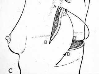 Breast reconstruction with lateral thoracodorsal flap + implant. Scheme of the flap harvesting and positioning