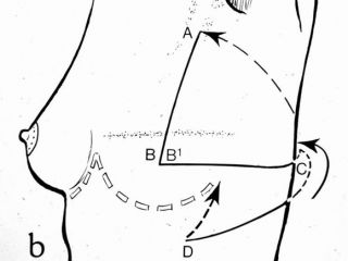 Breast reconstruction with lateral thoracodorsal flap + implant. Scheme of the preoperative drawings