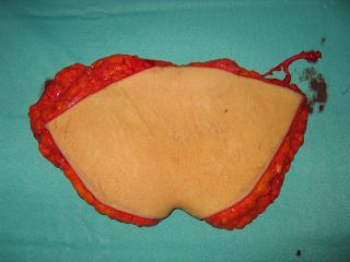 Breast Reconstruction with the DIEP flap. Intraoperative picture of the raised flap, cutaneous view. The flap has been rotated 180 degrees in order to demonstrate the positioning of the flap at the recipient site. Note the vascular pedicle