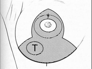 Schema: disegno preoperatorio in caso di wise-pattern lumpectomy. La 