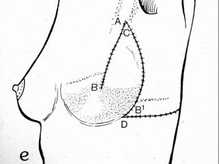 Breast reconstruction with lateral thoracodorsal flap + implant. Postoperative view (scheme)