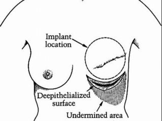 Introduction of mammary implant (scheme)